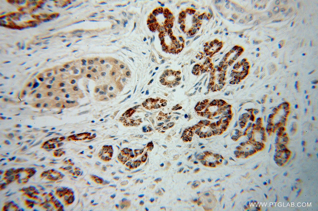 Immunohistochemistry (IHC) staining of human pancreas cancer tissue using NIT1 Polyclonal antibody (14380-1-AP)