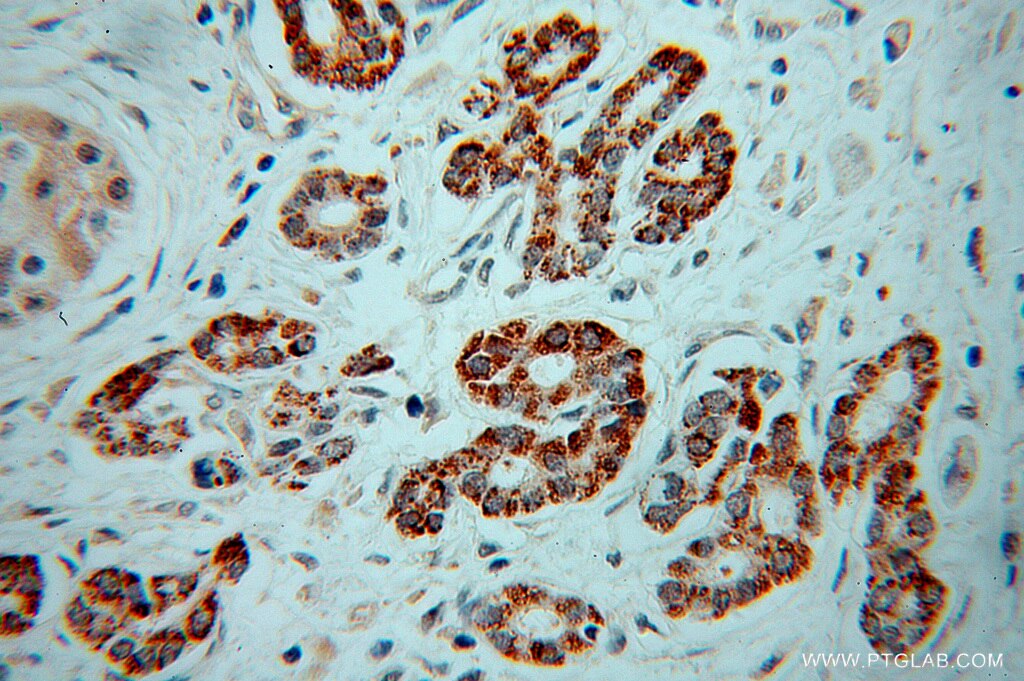 Immunohistochemistry (IHC) staining of human pancreas cancer tissue using NIT1 Polyclonal antibody (14380-1-AP)