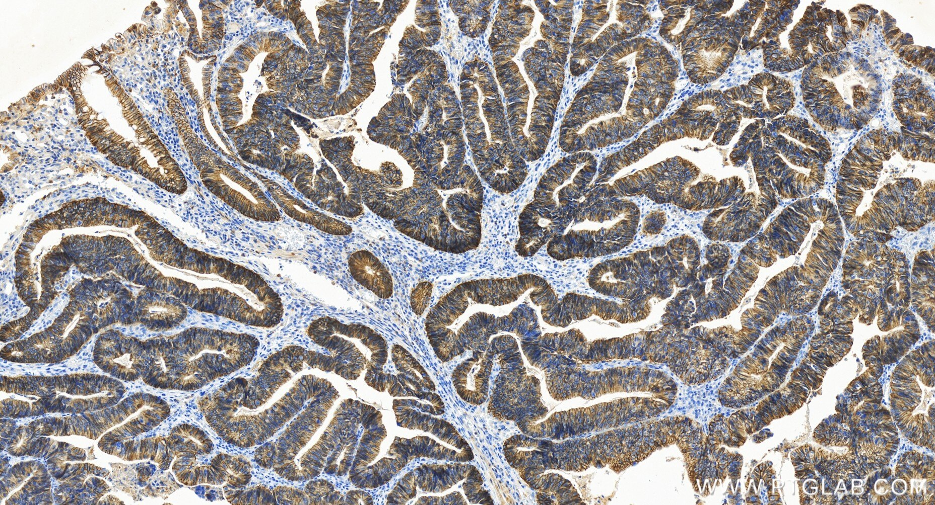 Immunohistochemical analysis of paraffin-embedded human colon cancer tissue slide using 86201-1-RR (NKCC1/SLC12A2 antibody) at dilution of 1:500 (under 20x lens). Heat mediated antigen retrieval with Tris-EDTA buffer (pH 9.0). Immunohistochemistry (IHC) staining of human colon cancer tissue using NKCC1/SLC12A2 Recombinant antibody (86201-1-RR)