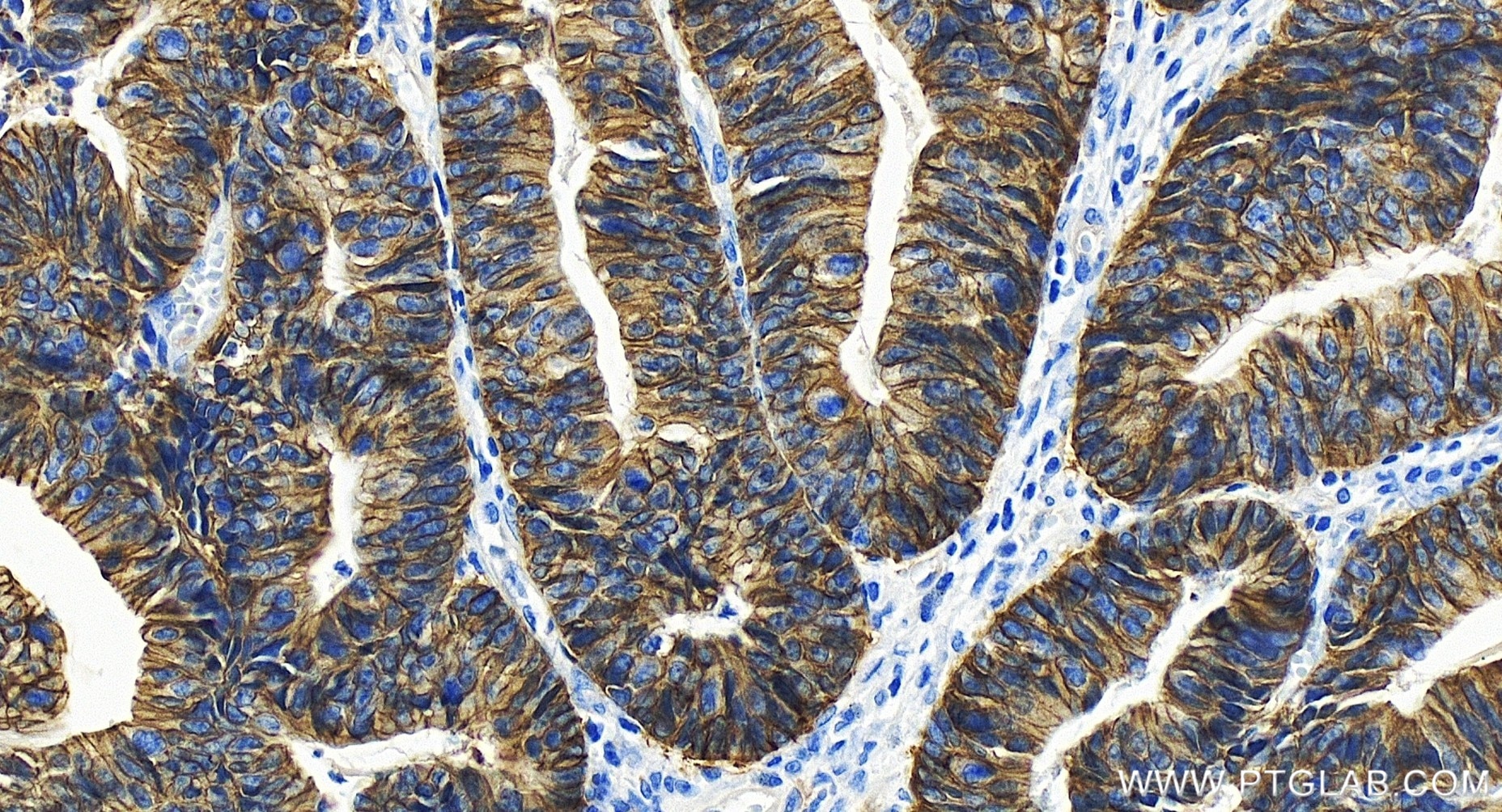 Immunohistochemical analysis of paraffin-embedded human colon cancer tissue slide using 86201-1-RR (NKCC1/SLC12A2 antibody) at dilution of 1:500 (under 20x lens). Heat mediated antigen retrieval with Tris-EDTA buffer (pH 9.0). Immunohistochemistry (IHC) staining of human colon cancer tissue using NKCC1/SLC12A2 Recombinant antibody (86201-1-RR)