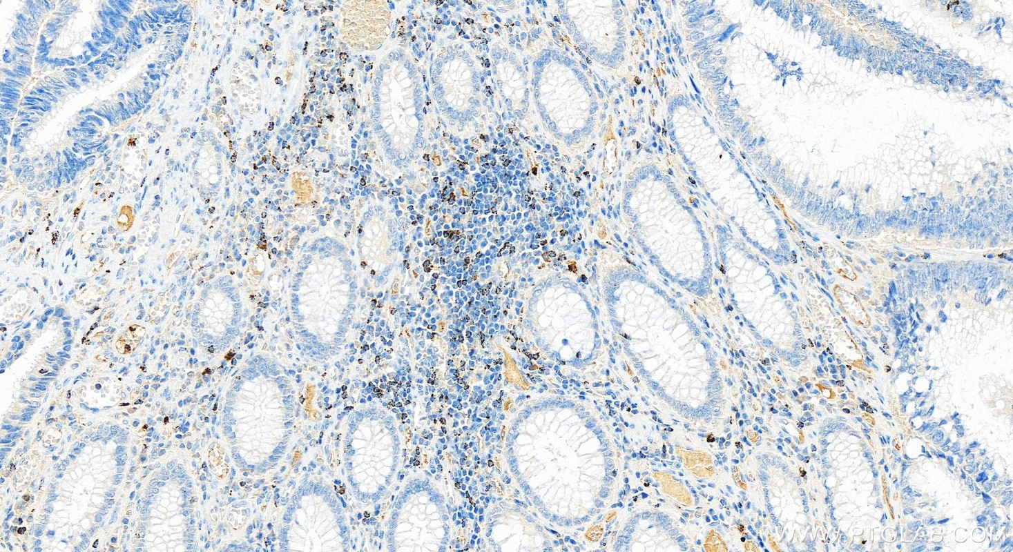 Immunohistochemistry (IHC) staining of human colon cancer tissue using NKG7 Polyclonal antibody (11532-1-AP)