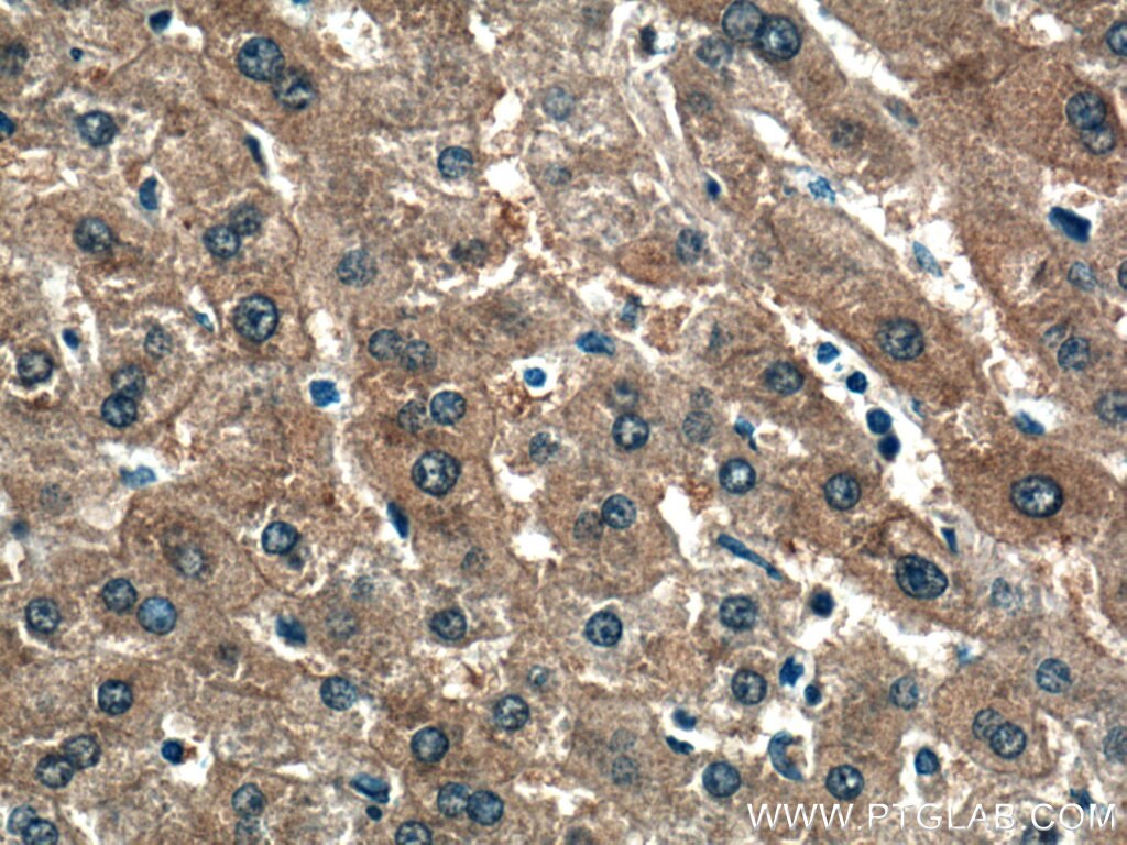 Immunohistochemistry (IHC) staining of human liver cancer tissue using NKPD1 Polyclonal antibody (28020-1-AP)