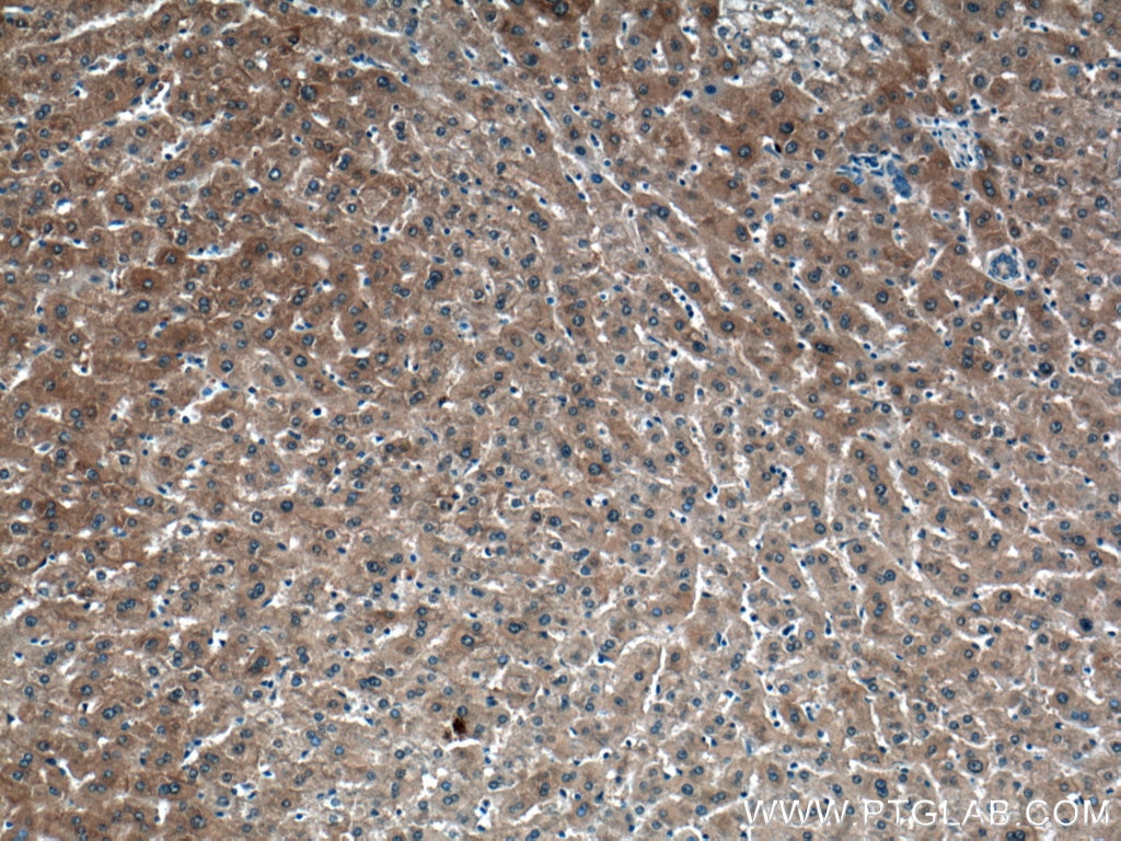 Immunohistochemistry (IHC) staining of human liver cancer tissue using NKPD1 Polyclonal antibody (28020-1-AP)