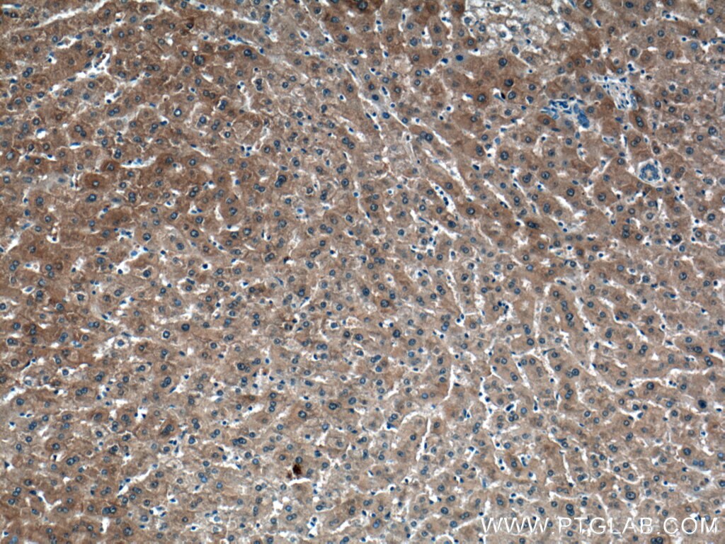 IHC staining of human liver cancer using 28020-1-AP