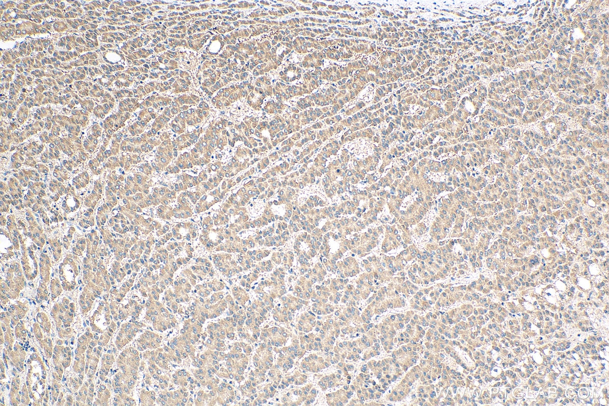 Immunohistochemistry (IHC) staining of human liver cancer tissue using NKTR Polyclonal antibody (19978-1-AP)
