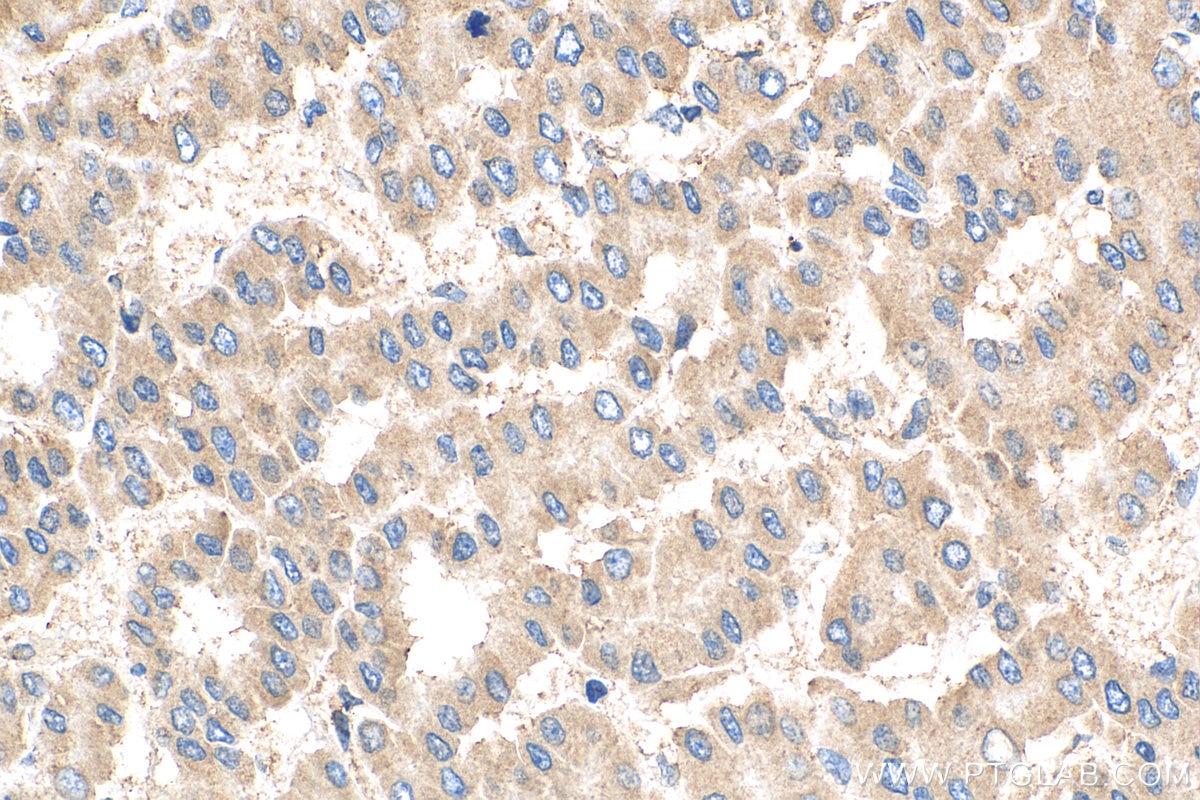 Immunohistochemistry (IHC) staining of human liver cancer tissue using NKTR Polyclonal antibody (19978-1-AP)