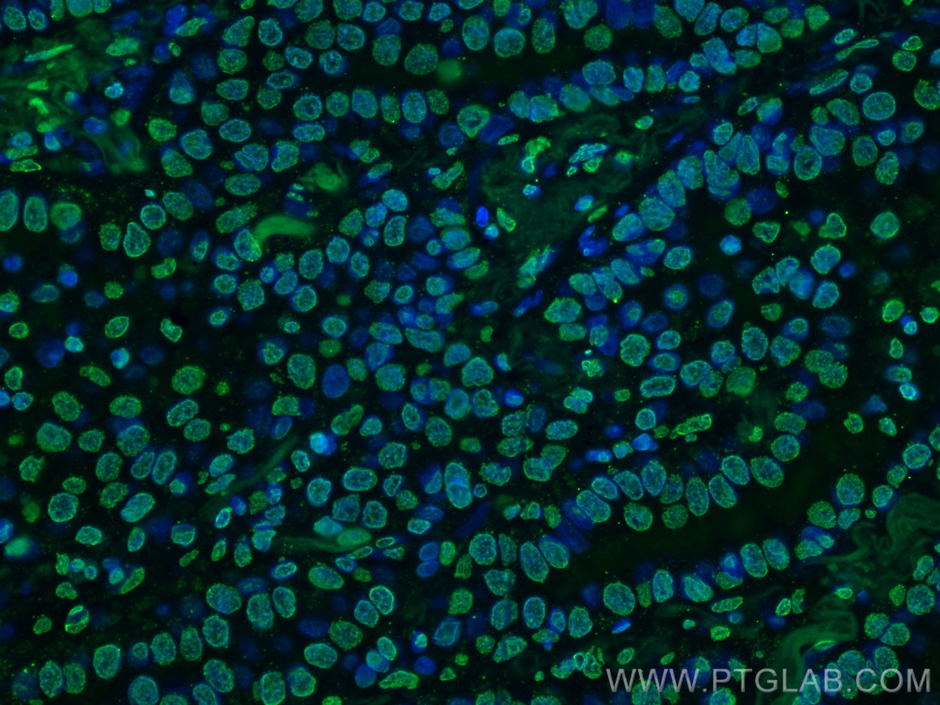 Immunofluorescence (IF) / fluorescent staining of human lung cancer tissue using TTF1 Monoclonal antibody (66034-1-Ig)