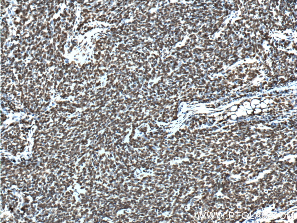 IHC staining of human lung cancer using 66034-1-Ig