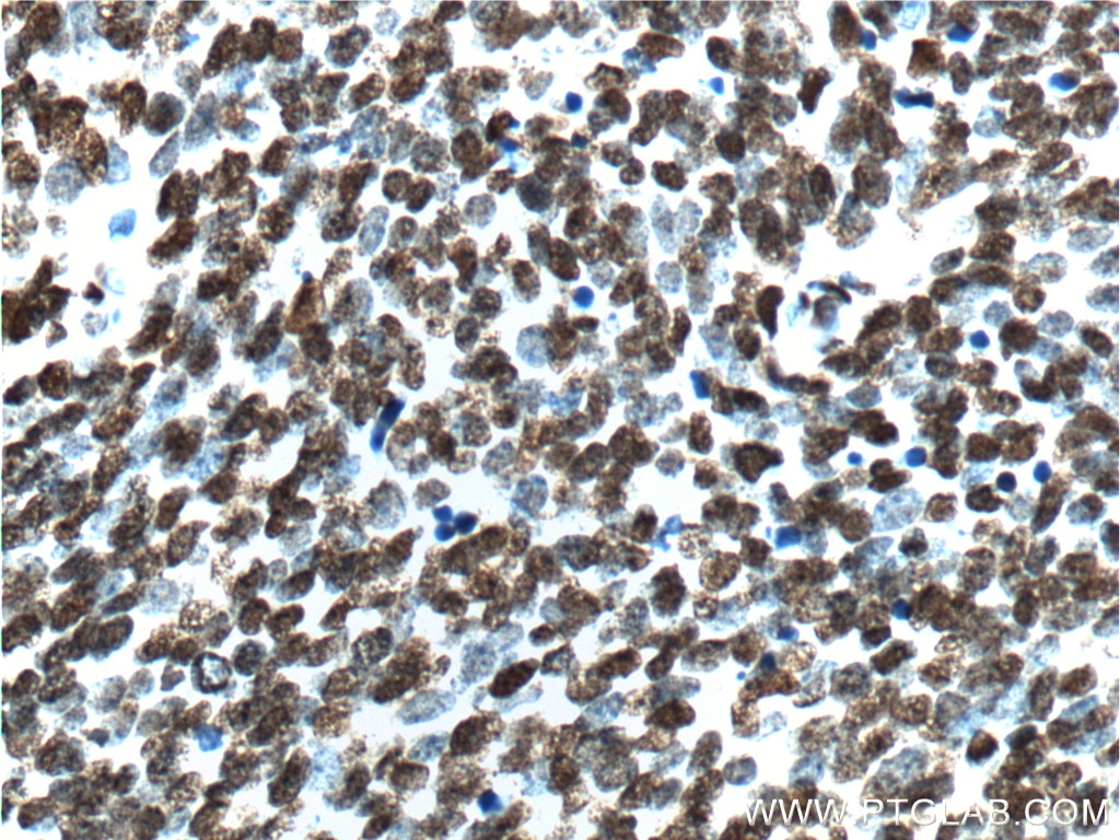 Immunohistochemistry (IHC) staining of human lung cancer tissue using TTF1 Monoclonal antibody (66034-1-Ig)