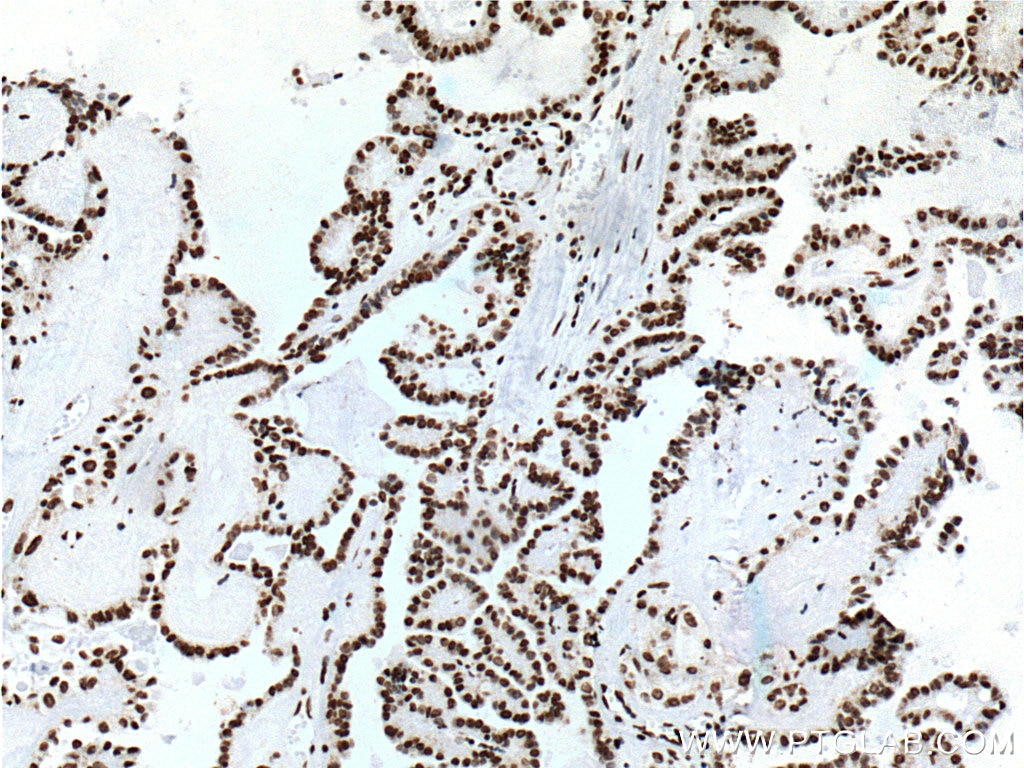 Immunohistochemistry (IHC) staining of human thyroid cancer tissue using TTF1 Monoclonal antibody (66034-1-Ig)