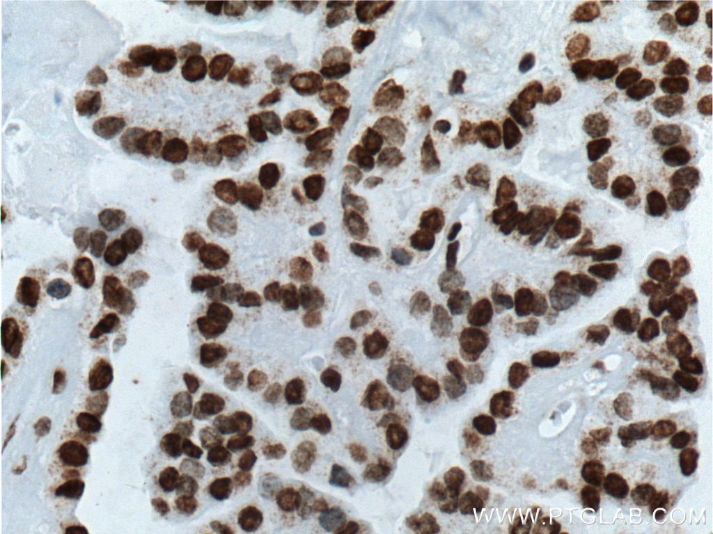 Immunohistochemistry (IHC) staining of human thyroid cancer tissue using TTF1 Monoclonal antibody (66034-1-Ig)