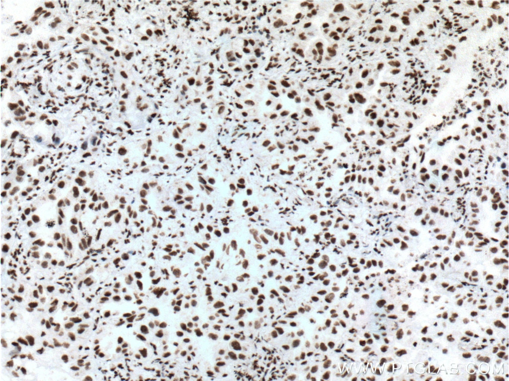 IHC staining of human lung cancer using 66034-1-Ig