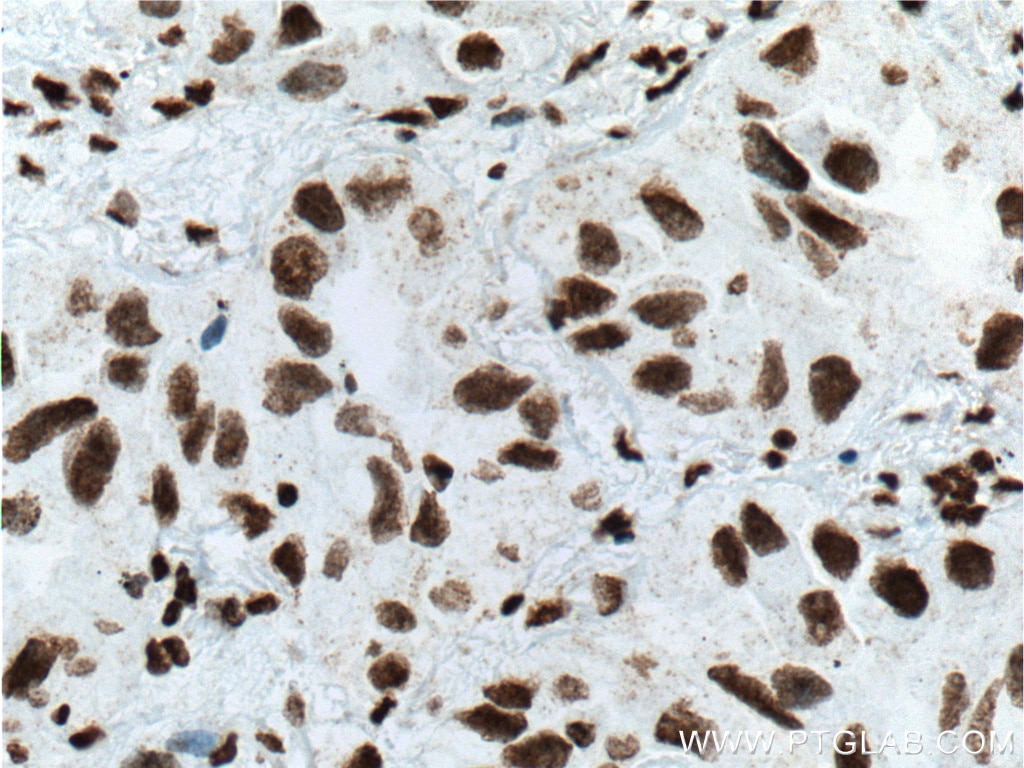 Immunohistochemistry (IHC) staining of human lung cancer tissue using TTF1 Monoclonal antibody (66034-1-Ig)