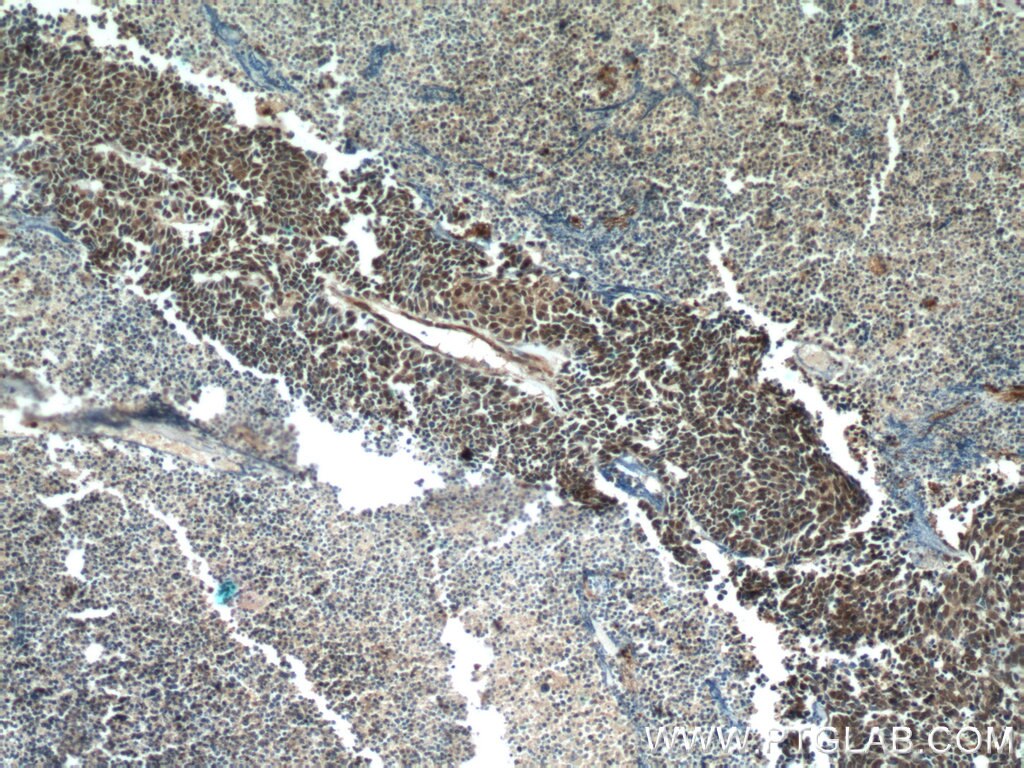 Immunohistochemistry (IHC) staining of human lung cancer tissue using TTF1 Monoclonal antibody (66034-1-Ig)