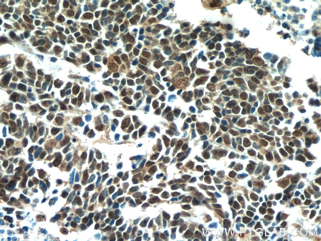 Immunohistochemistry (IHC) staining of human lung cancer tissue using TTF1 Monoclonal antibody (66034-1-Ig)