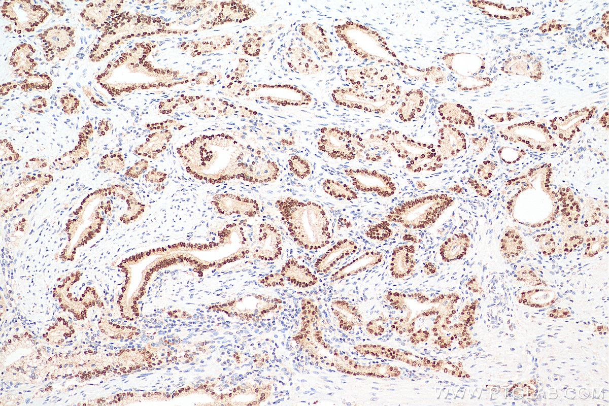 Immunohistochemistry (IHC) staining of human prostate cancer tissue using NKX3-1 Polyclonal antibody (13069-1-AP)