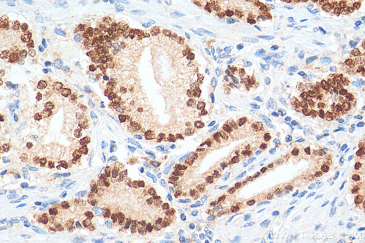 Immunohistochemistry (IHC) staining of human prostate cancer tissue using NKX3-1 Polyclonal antibody (13069-1-AP)