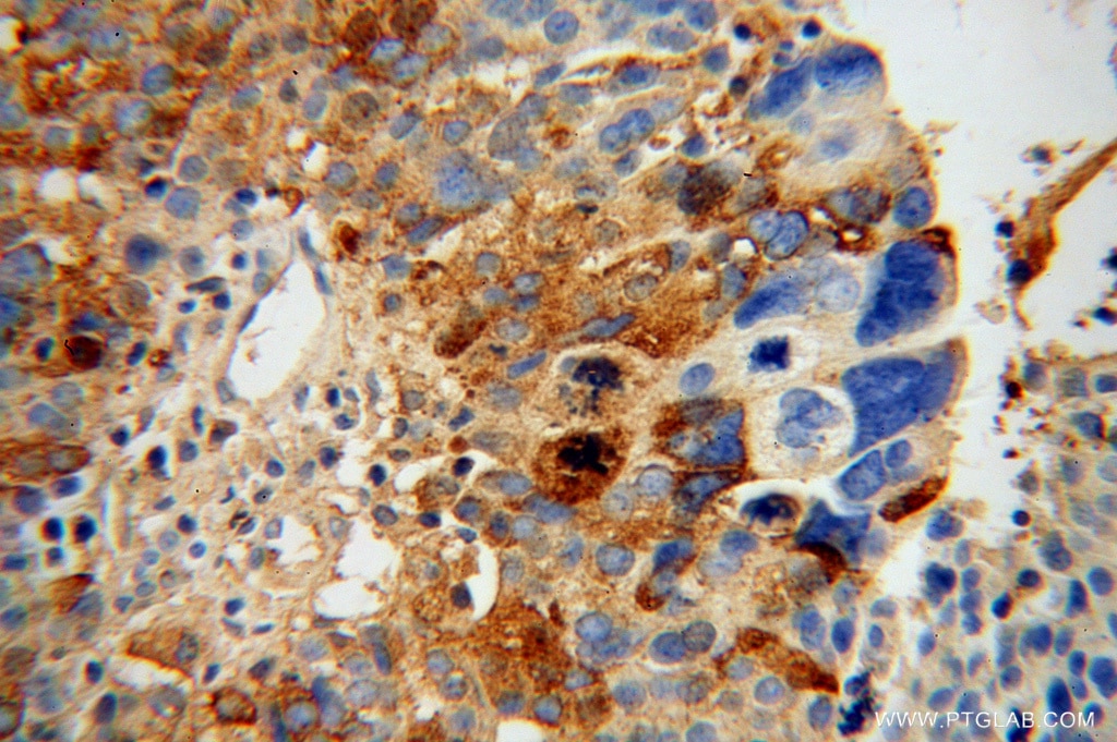 Immunohistochemistry (IHC) staining of human ovary tumor tissue using NLN Polyclonal antibody (14763-1-AP)