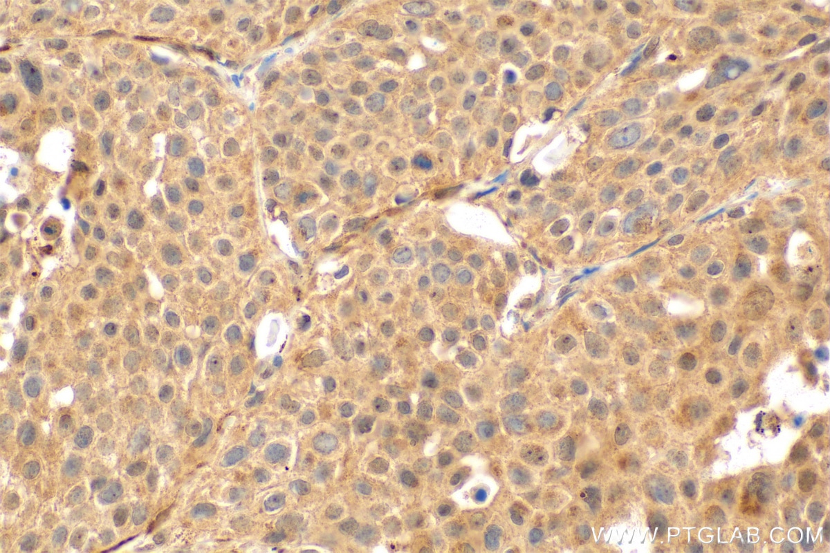 Immunohistochemistry (IHC) staining of human lung cancer tissue using NLRC5 Polyclonal antibody (31067-1-AP)