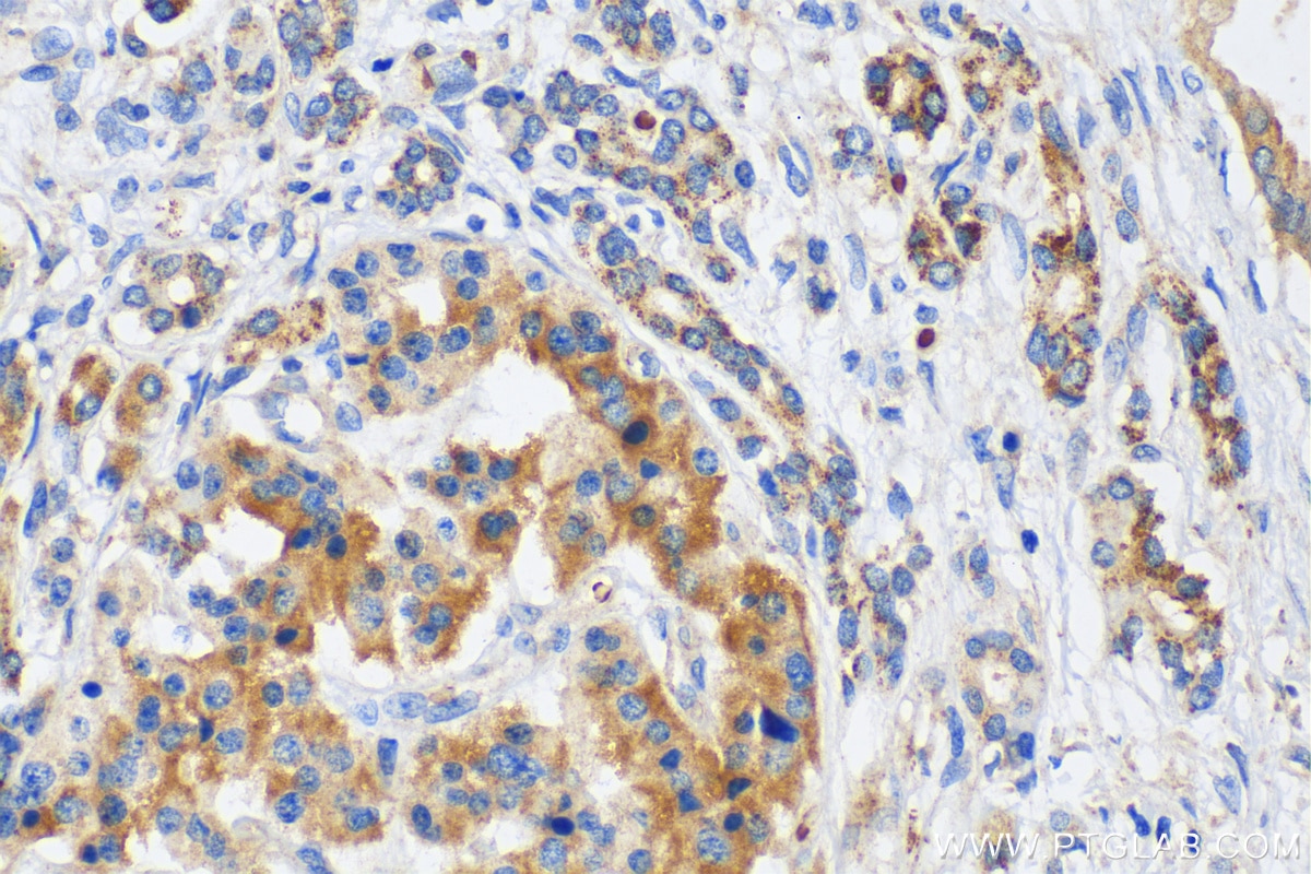 Immunohistochemistry (IHC) staining of human pancreas cancer tissue using NLRP1 Polyclonal antibody (12256-1-AP)