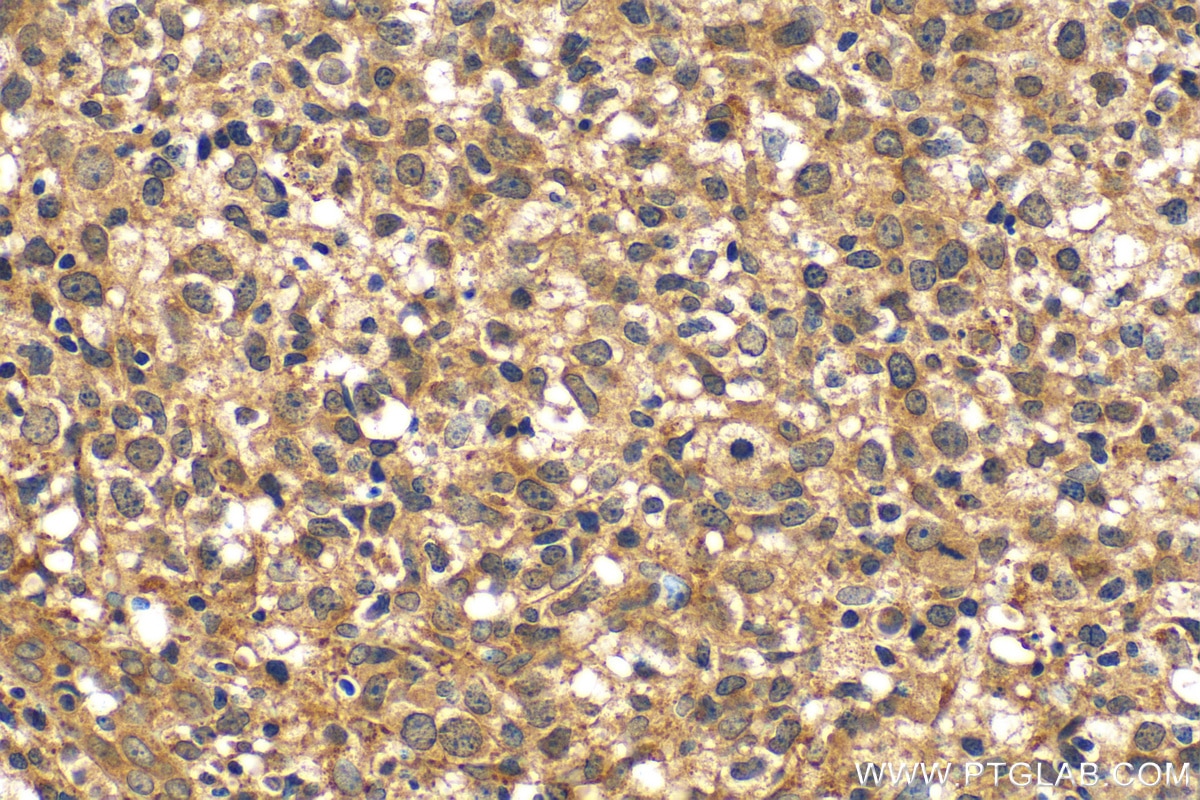 Immunohistochemistry (IHC) staining of human lymphoma tissue using NLRP1 Polyclonal antibody (12256-1-AP)