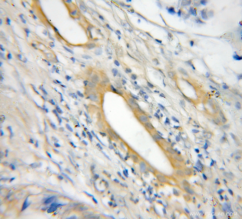 Immunohistochemistry (IHC) staining of human pancreas cancer tissue using NLRP1 Polyclonal antibody (12256-1-AP)