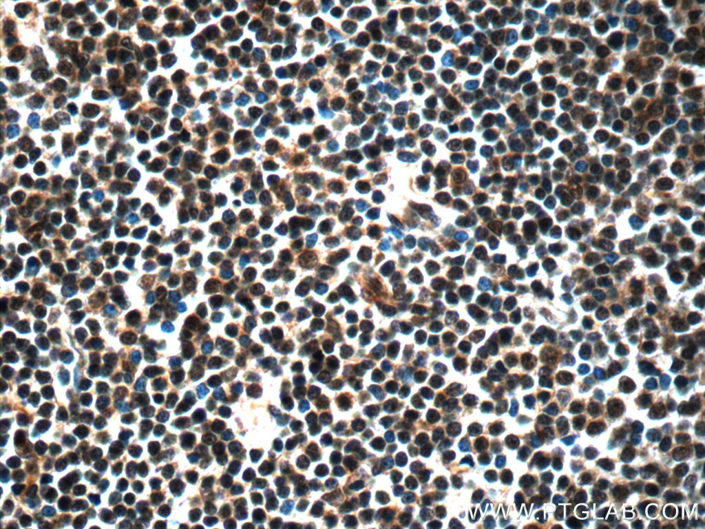 Immunohistochemistry (IHC) staining of human lymphoma tissue using NLRP1 Polyclonal antibody (24792-1-AP)