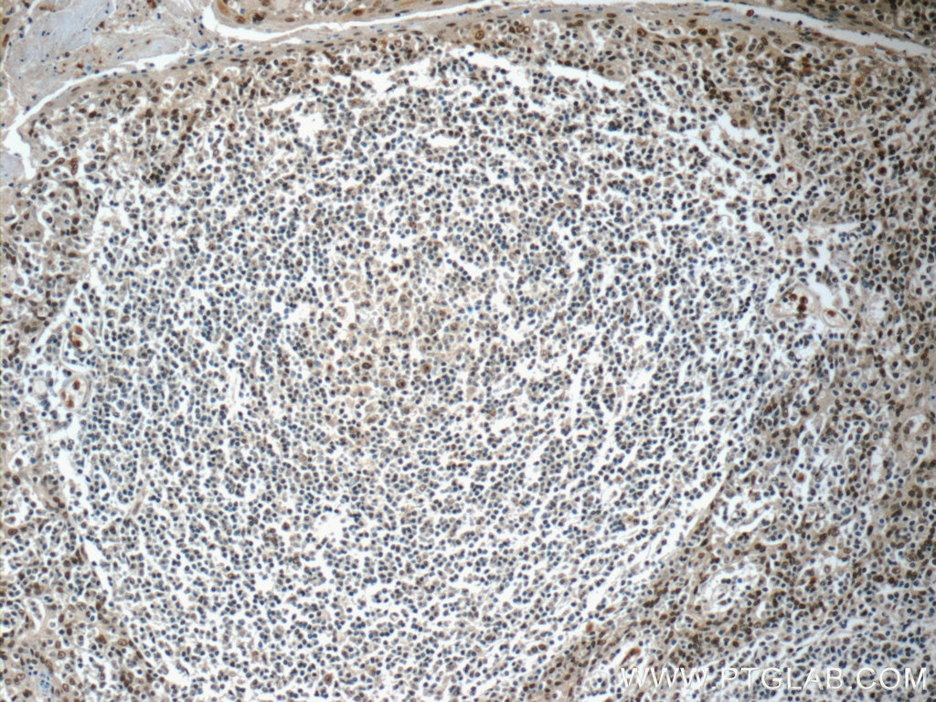 Immunohistochemistry (IHC) staining of human tonsillitis tissue using NALP1 Polyclonal antibody (24792-1-AP)