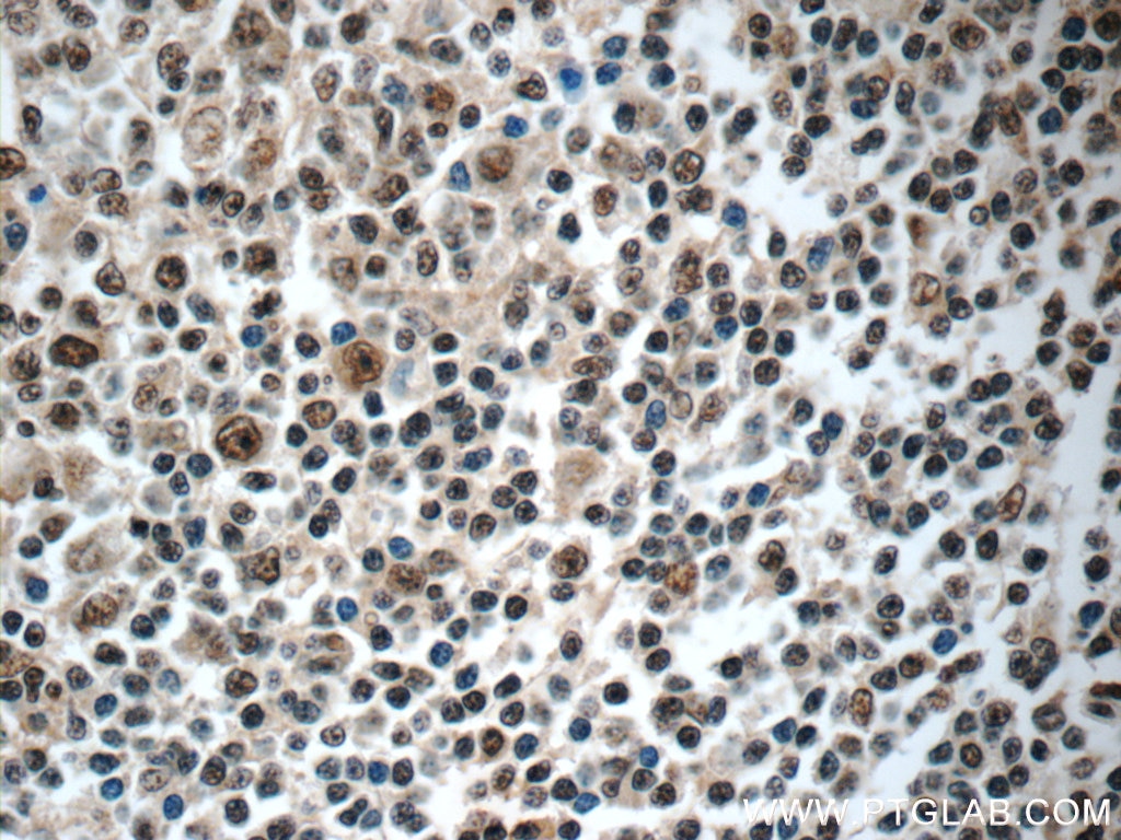 Immunohistochemistry (IHC) staining of human tonsillitis tissue using NALP1 Polyclonal antibody (24792-1-AP)