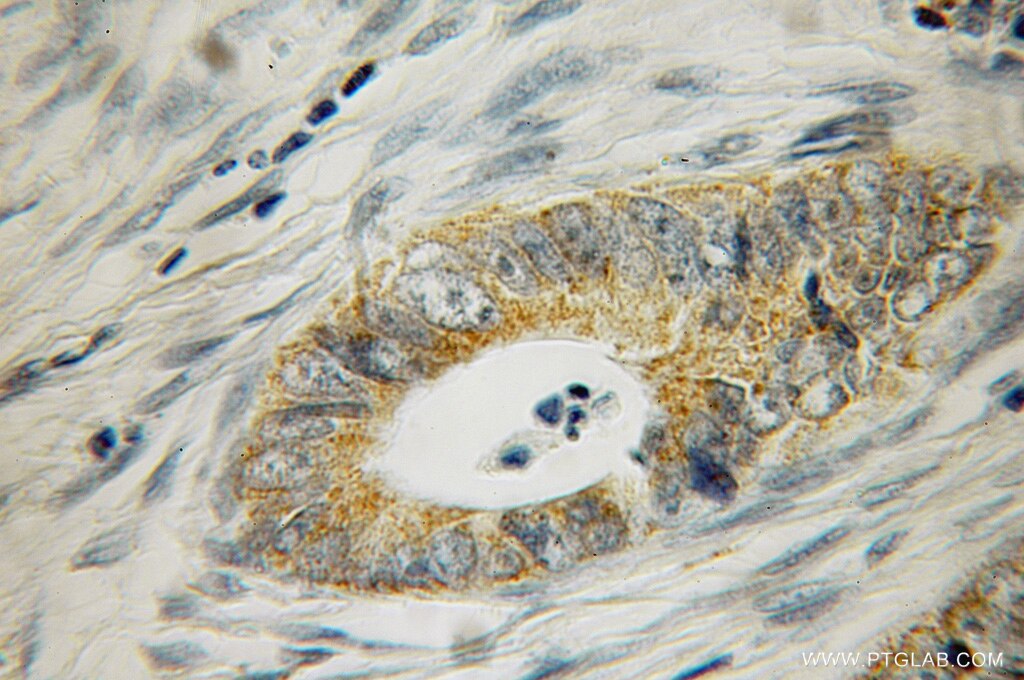 Immunohistochemistry (IHC) staining of human colon cancer tissue using NLRP2 Polyclonal antibody (12873-1-AP)