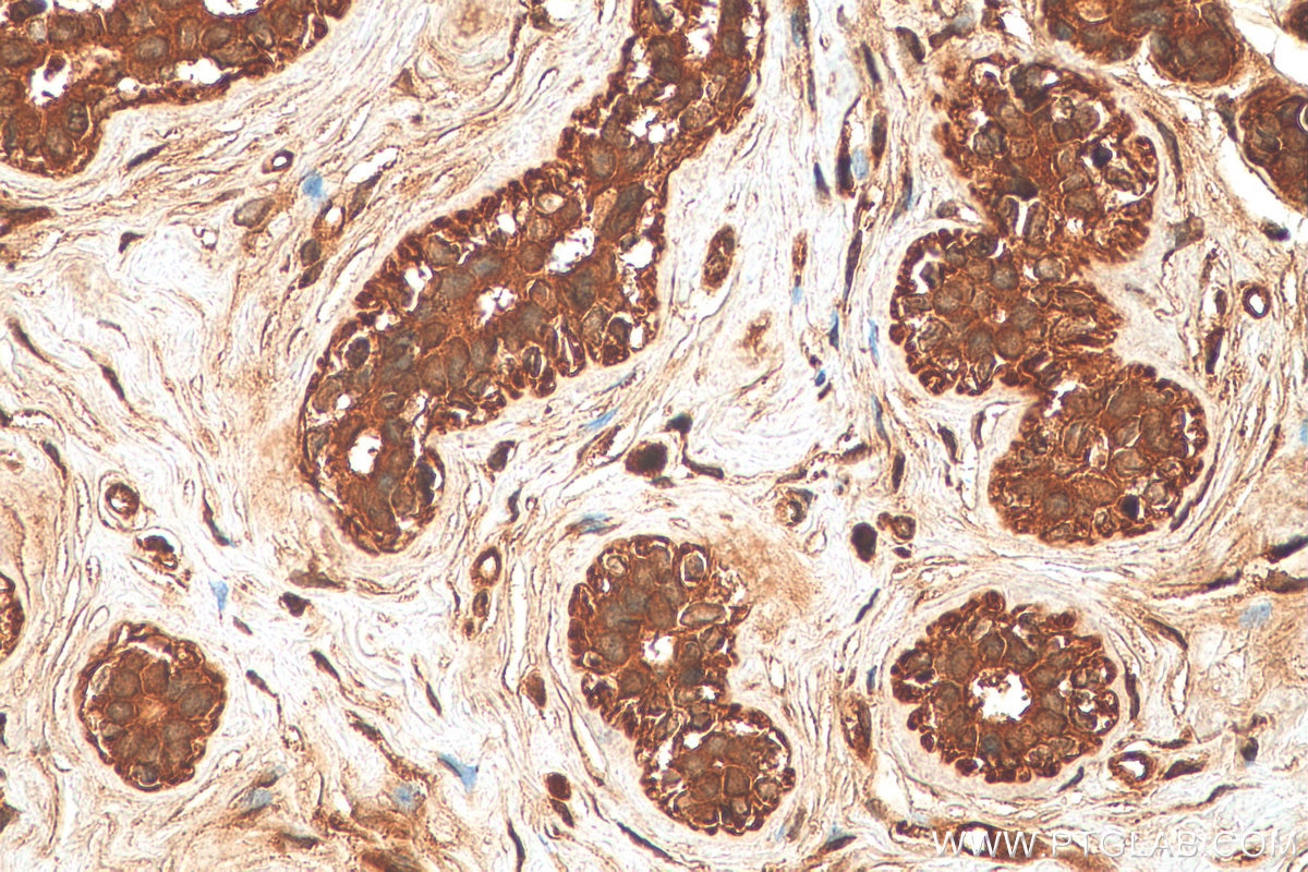 Immunohistochemistry (IHC) staining of human breast cancer tissue using NLRP3 Polyclonal antibody (27458-1-AP)