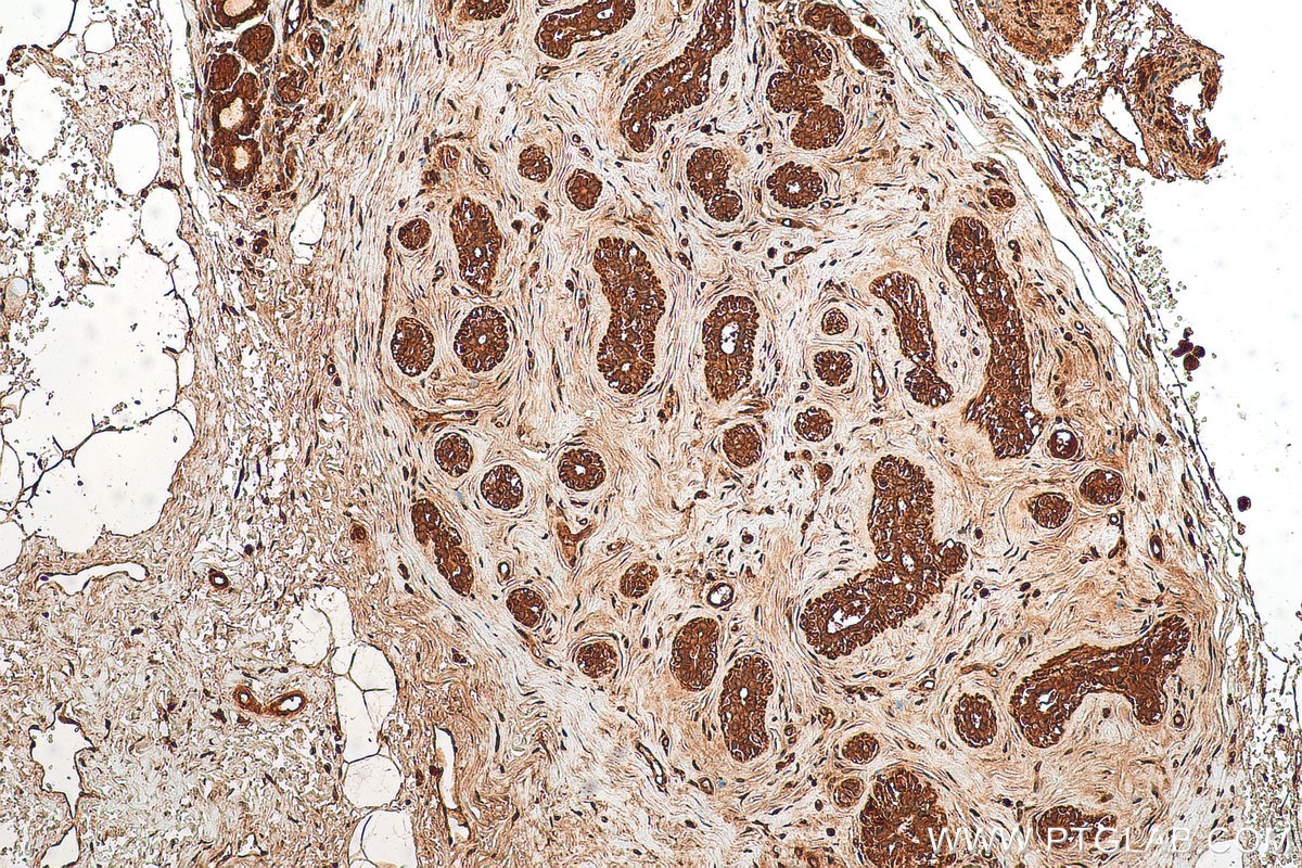 Immunohistochemistry (IHC) staining of human breast cancer tissue using NLRP3 Polyclonal antibody (27458-1-AP)