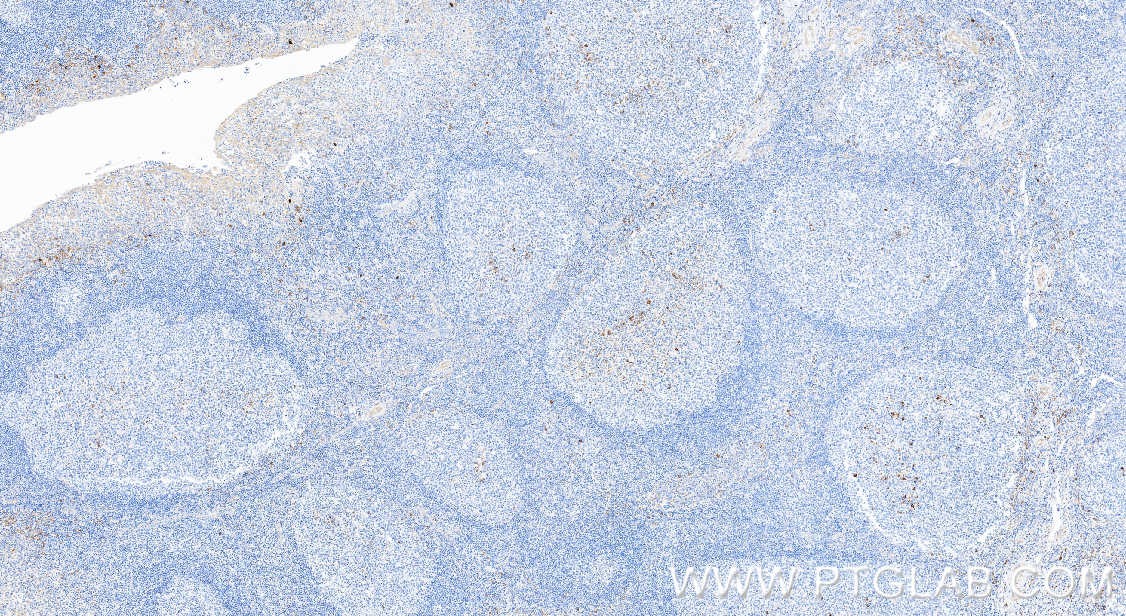 Immunohistochemistry (IHC) staining of human tonsillitis tissue using NLRP3 Recombinant monoclonal antibody (82453-2-RR)