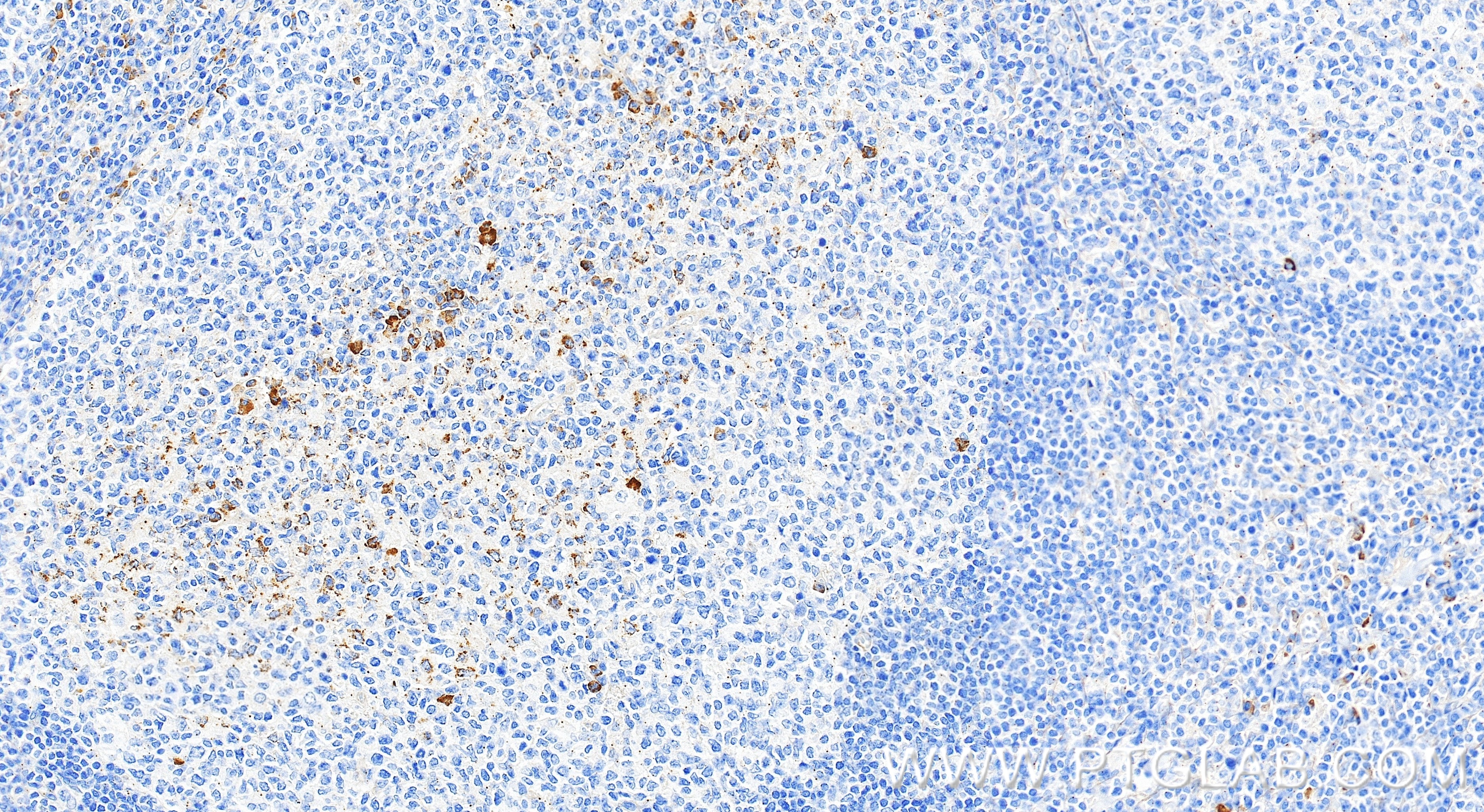 Immunohistochemistry (IHC) staining of human tonsillitis tissue using NLRP3 Recombinant monoclonal antibody (82453-2-RR)