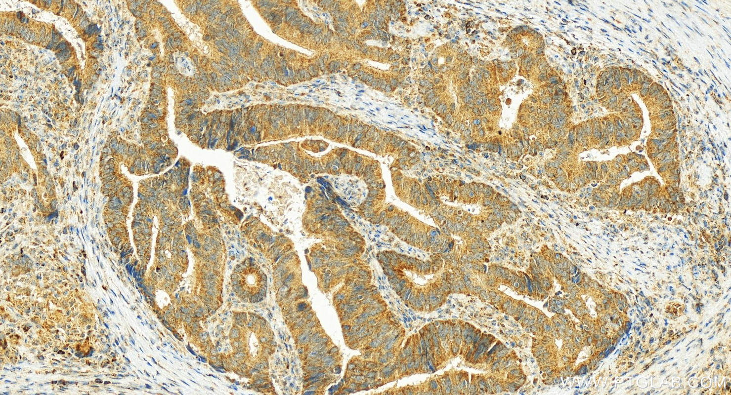 Immunohistochemistry (IHC) staining of human colon cancer tissue using NLRP6 Polyclonal antibody (30973-1-AP)