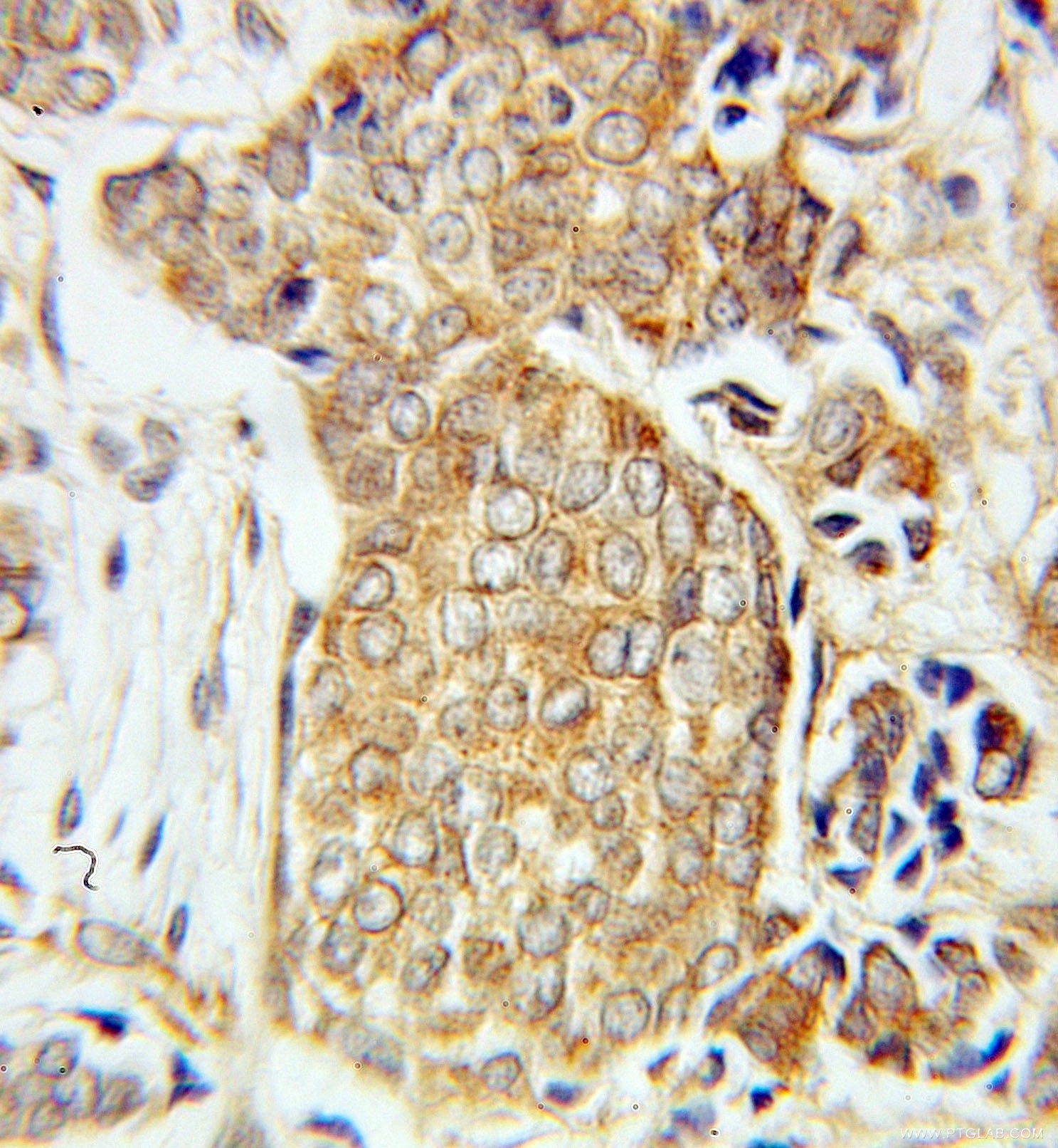 IHC staining of human breast cancer using 10888-1-AP