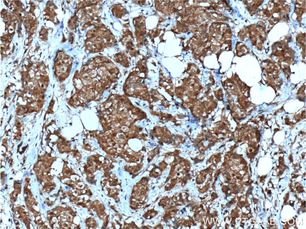 Immunohistochemistry (IHC) staining of human breast cancer tissue using NMD3 Polyclonal antibody (16060-1-AP)