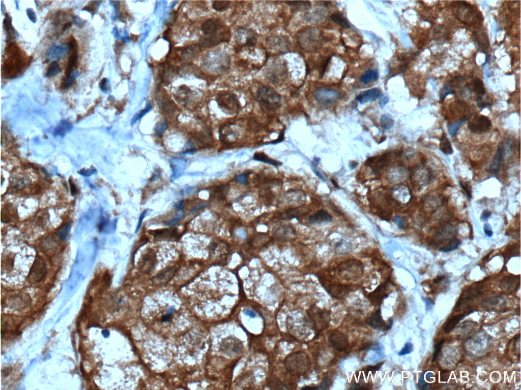 Immunohistochemistry (IHC) staining of human breast cancer tissue using NMD3 Polyclonal antibody (16060-1-AP)
