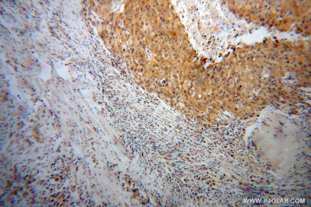 Immunohistochemistry (IHC) staining of human lung cancer tissue using NME1 Polyclonal antibody (11086-2-AP)