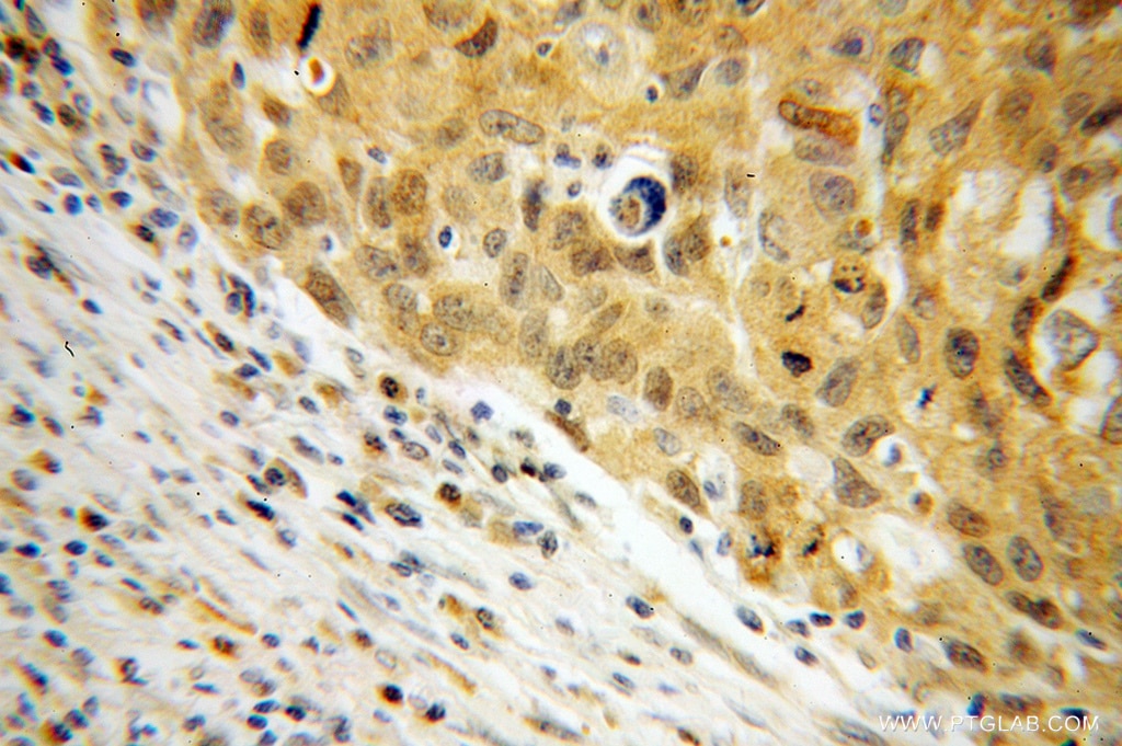 Immunohistochemistry (IHC) staining of human lung cancer tissue using NME1 Polyclonal antibody (11086-2-AP)