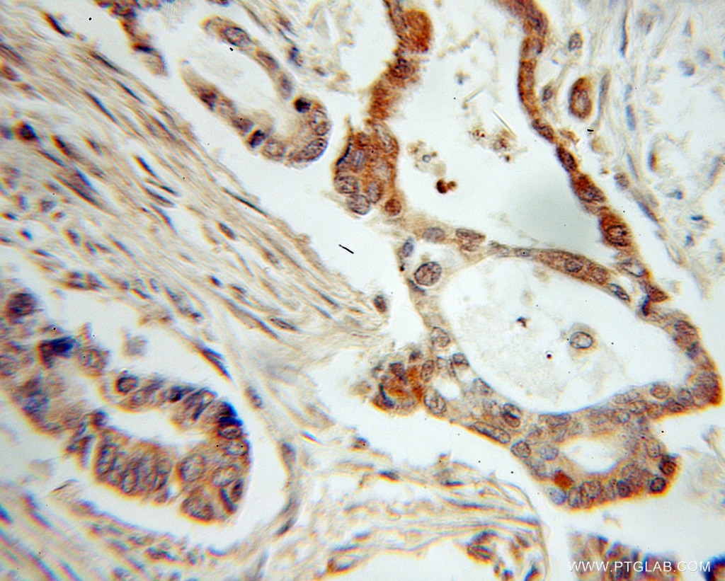 IHC staining of human pancreas cancer using 11086-2-AP