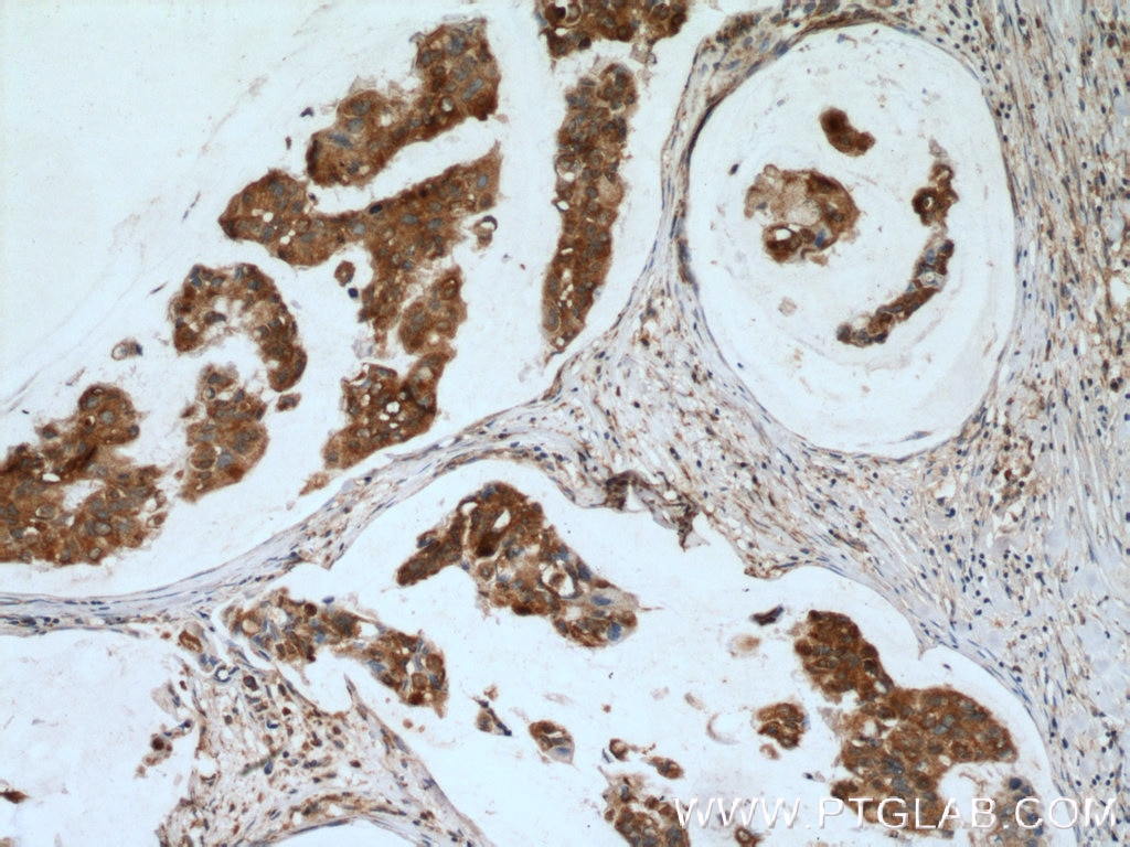 Immunohistochemistry (IHC) staining of human breast cancer tissue using NME3 Polyclonal antibody (15136-1-AP)