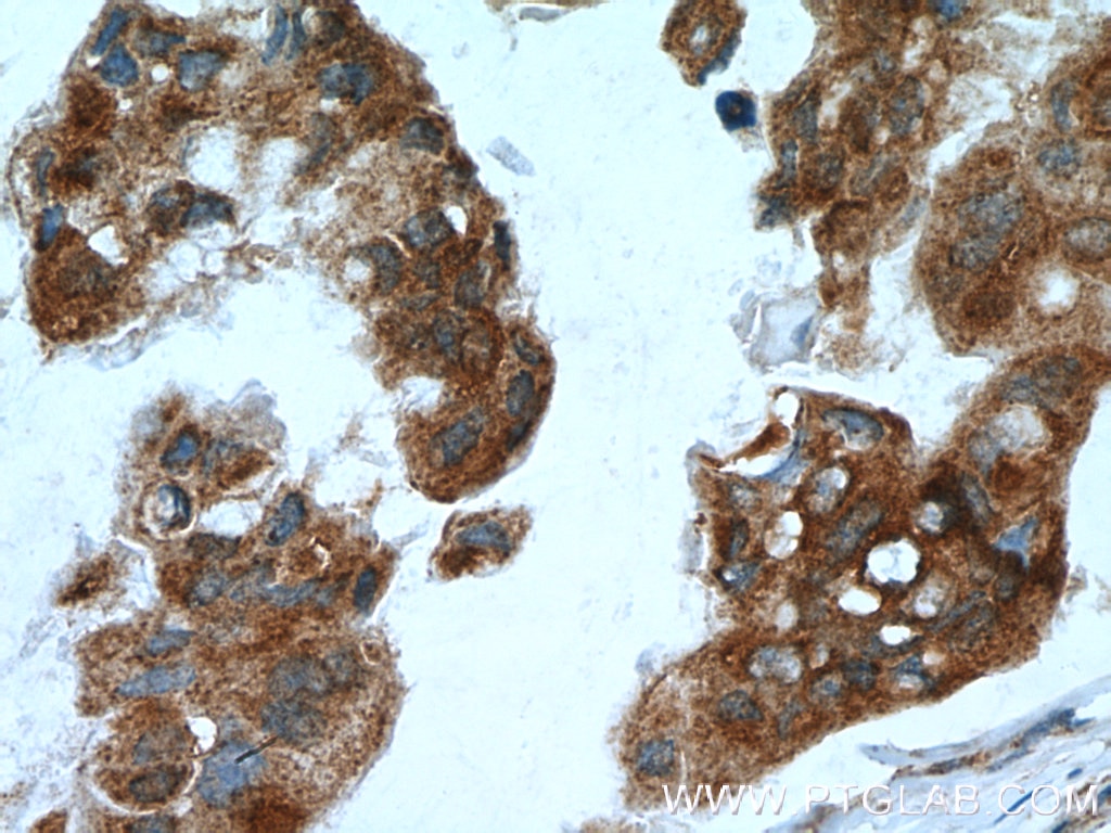 Immunohistochemistry (IHC) staining of human breast cancer tissue using NME3 Polyclonal antibody (15136-1-AP)