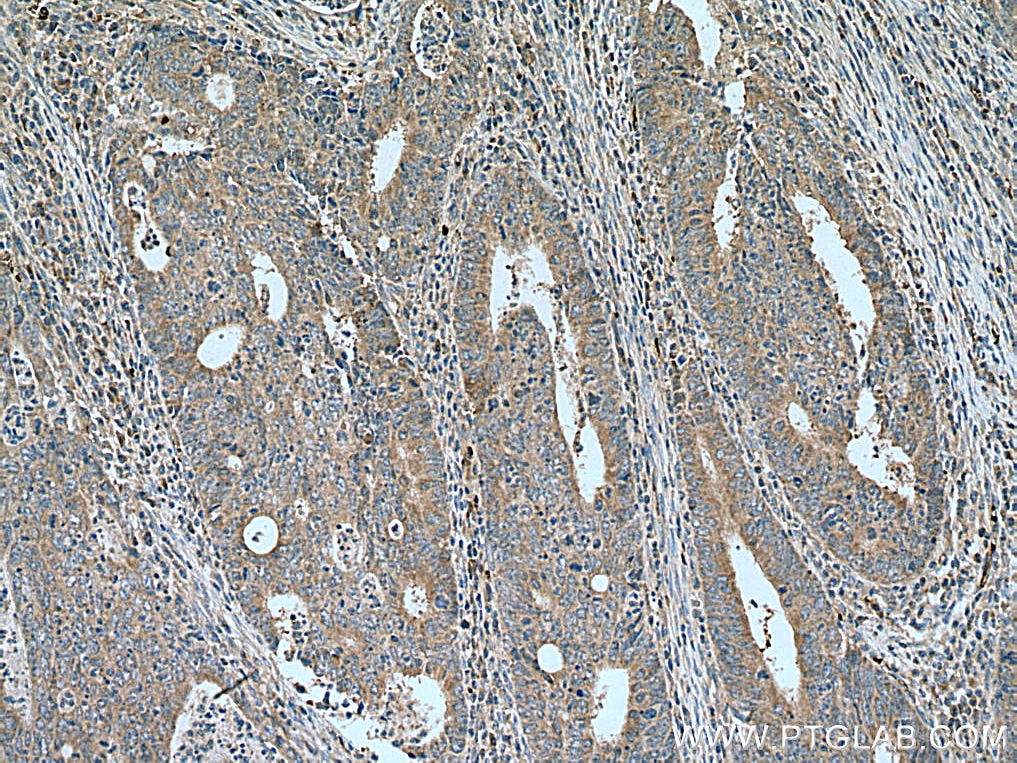 Immunohistochemistry (IHC) staining of human colon cancer tissue using NME6 Polyclonal antibody (10250-1-AP)
