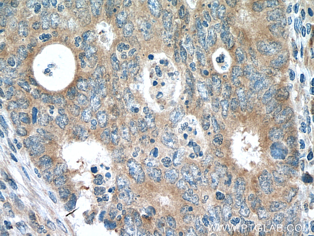Immunohistochemistry (IHC) staining of human colon cancer tissue using NME6 Polyclonal antibody (10250-1-AP)