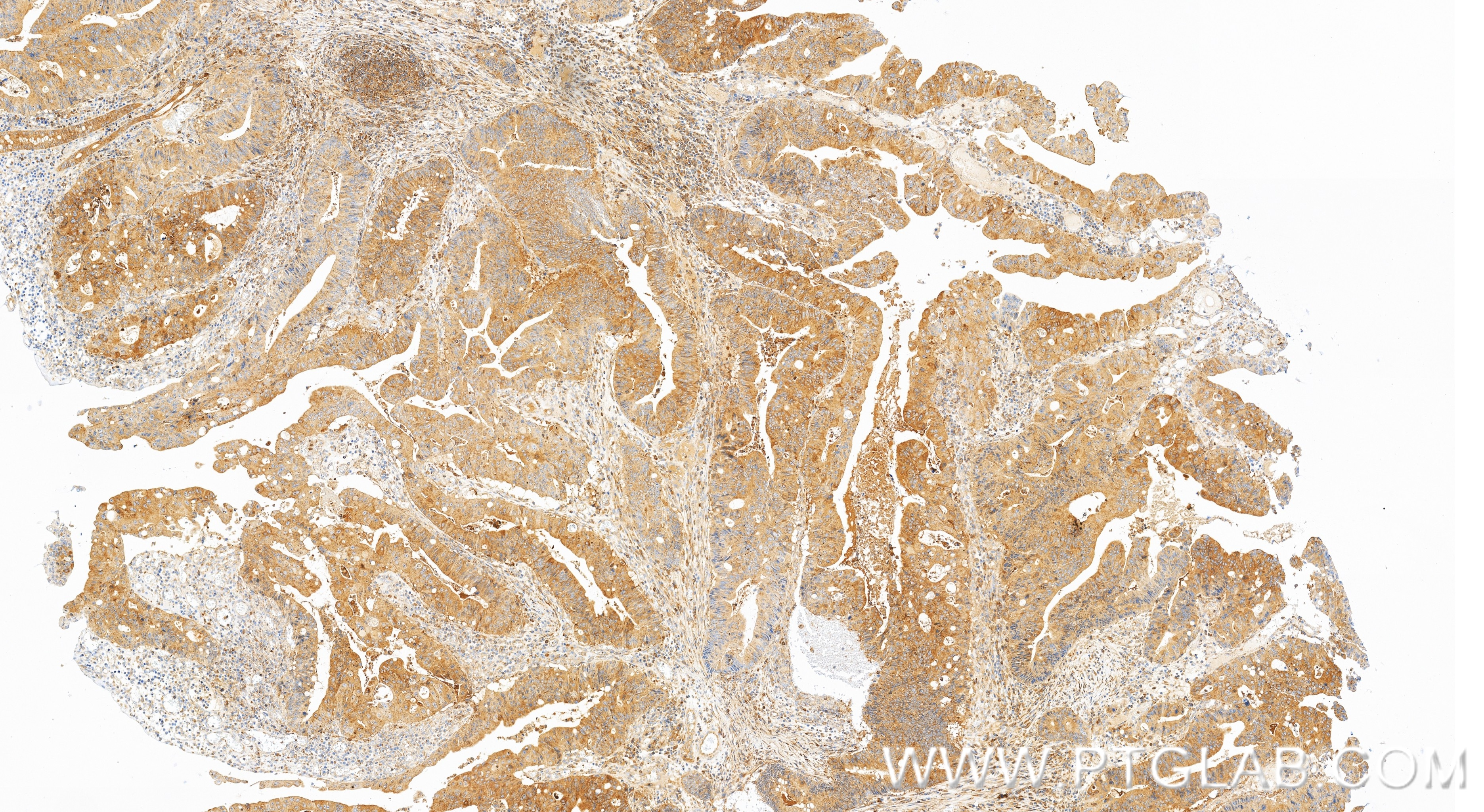 IHC staining of human colon cancer using 83986-2-RR Immunohistochemistry (IHC) staining of human colon cancer tissue using NMI Recombinant monoclonal antibody (83986-2-RR)