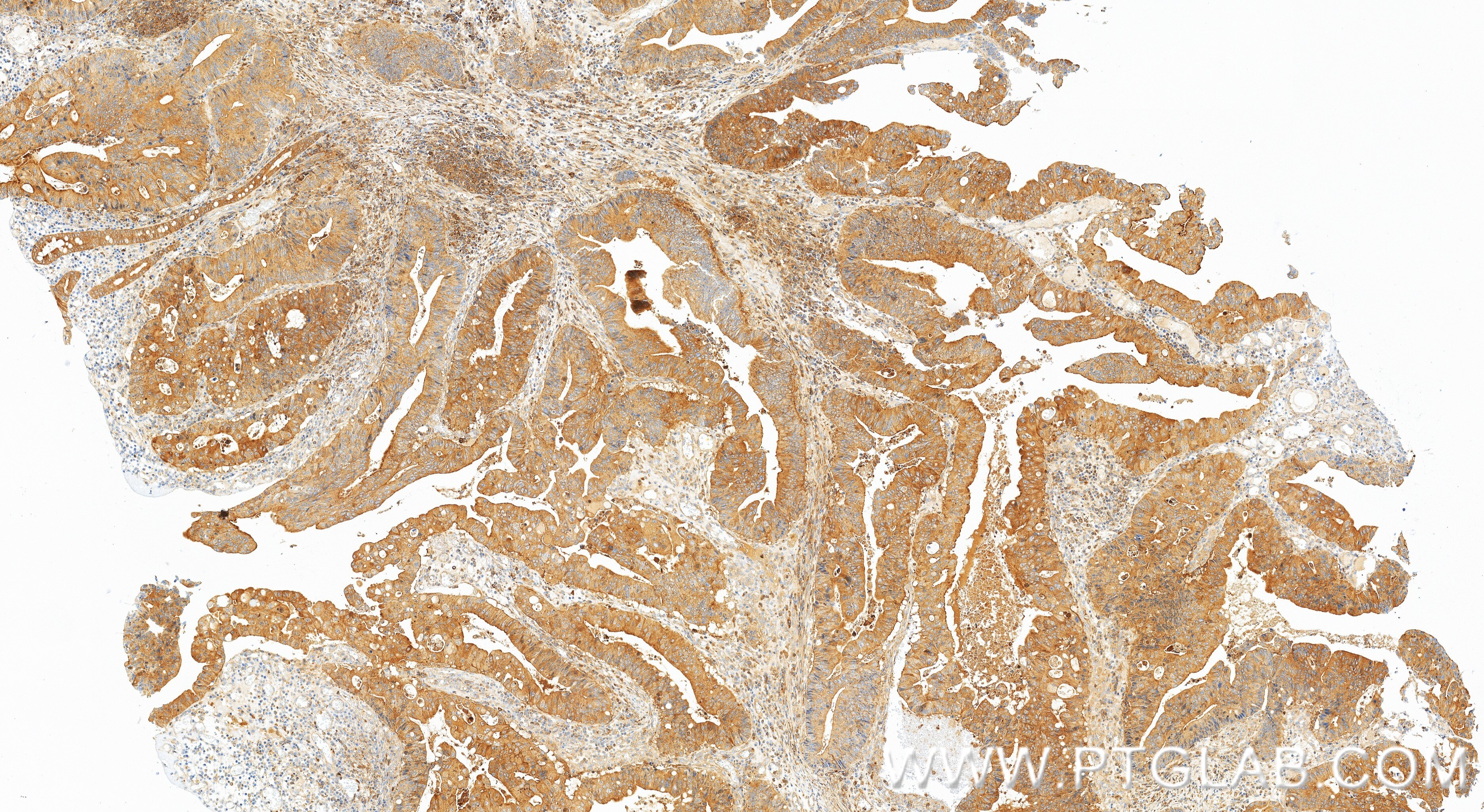 Immunohistochemistry (IHC) staining of human colon cancer tissue using NMI Recombinant monoclonal antibody (83986-5-RR)