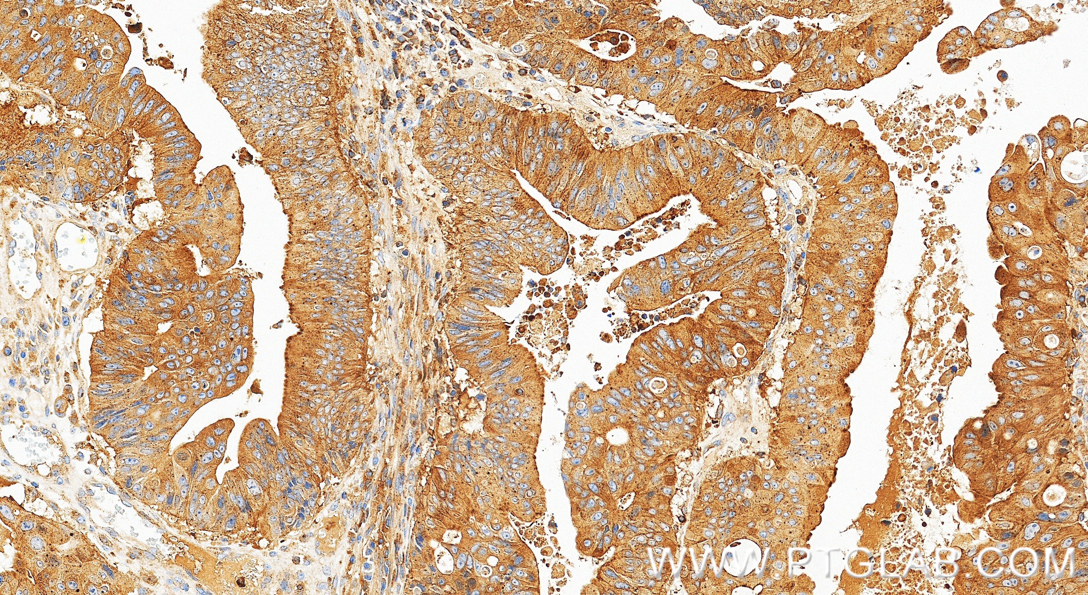 Immunohistochemistry (IHC) staining of human colon cancer tissue using NMI Recombinant monoclonal antibody (83986-5-RR)