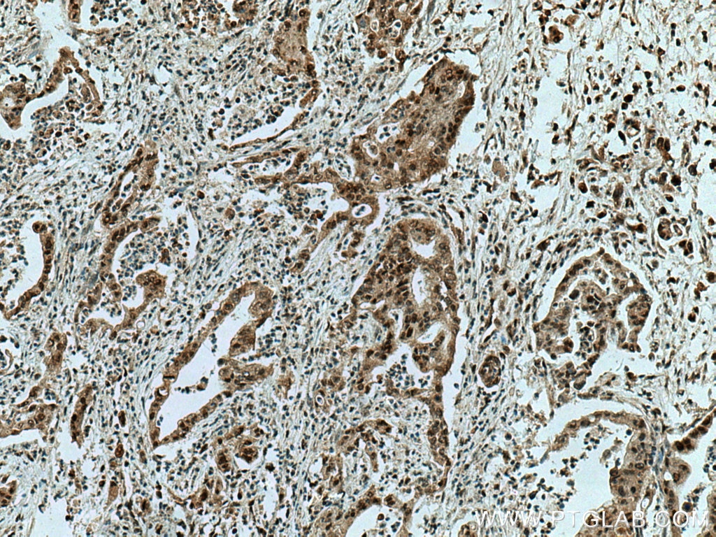 IHC staining of human pancreas cancer using 11399-1-AP