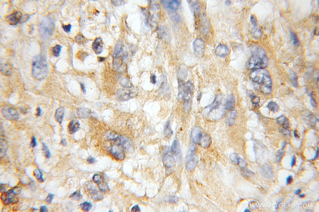 Immunohistochemistry (IHC) staining of human gliomas tissue using NMT1 Polyclonal antibody (11546-1-AP)
